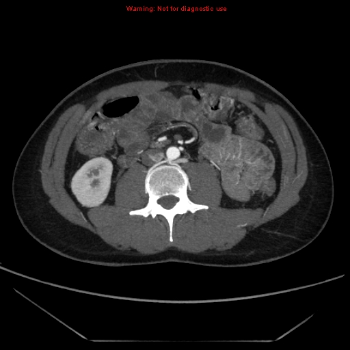 File:Circumaortic left renal vein (Radiopaedia 9069-9792 A 35).jpg