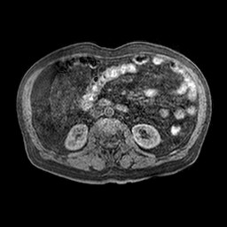 Cirrhosis and hepatocellular carcinoma in the setting of hemochromatosis (Radiopaedia 75394-86594 Axial T1 C+ fat sat 11).jpg
