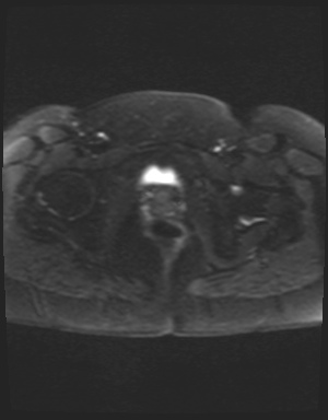 Class II Mullerian duct anomaly- unicornuate uterus with rudimentary horn and non-communicating cavity (Radiopaedia 39441-41755 Axial DWI 24).jpg