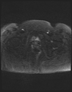 File:Class II Mullerian duct anomaly- unicornuate uterus with rudimentary horn and non-communicating cavity (Radiopaedia 39441-41755 Axial DWI 56).jpg