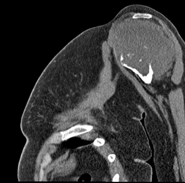 Clear cell chondrosarcoma - humerus (Radiopaedia 63104-71612 D 25).jpg