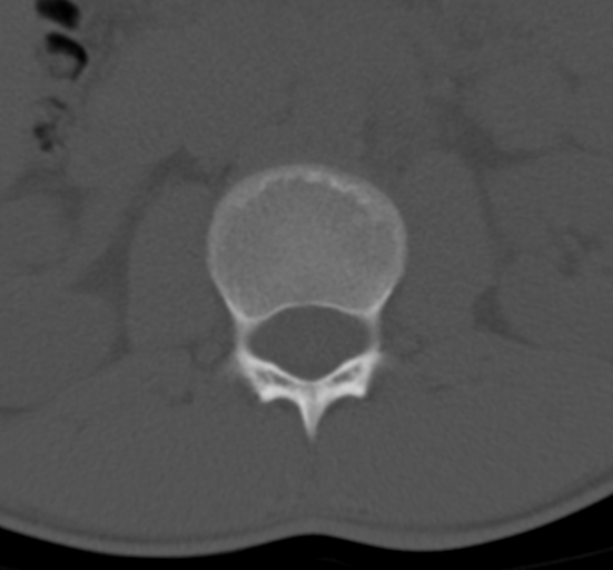 Clear cell meningoma - lumbar spine (Radiopaedia 60116-67691 Axial bone window 17).png