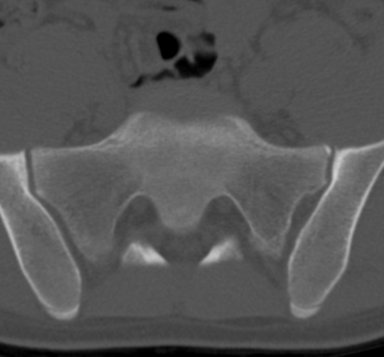 Clear cell meningoma - lumbar spine (Radiopaedia 60116-67691 Axial bone window 71).png