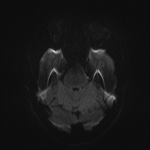 File:Clival meningioma (Radiopaedia 53278-59248 Axial DWI 32).jpg