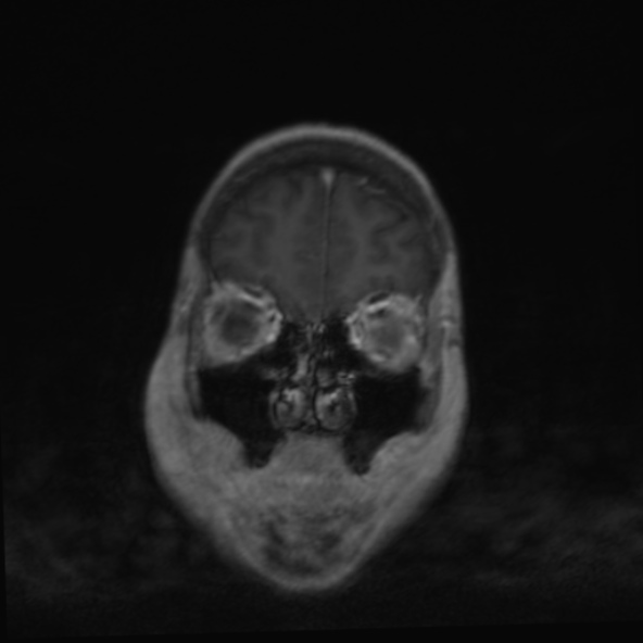 File:Clival meningioma (Radiopaedia 53278-59248 F 6).jpg