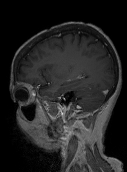 File:Clival meningioma (Radiopaedia 53278-59248 Sagittal T1 C+ 319).jpg