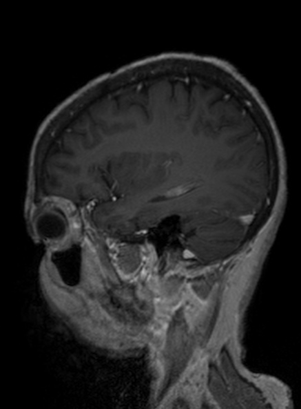 File:Clival meningioma (Radiopaedia 53278-59248 Sagittal T1 C+ 325).jpg