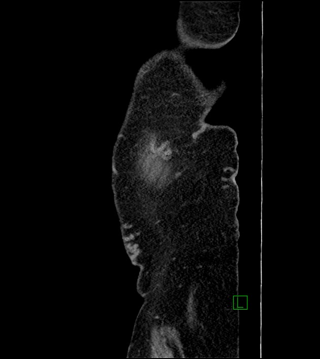 Closed-loop small bowel obstruction-internal hernia (Radiopaedia 78439-91096 C 138).jpg