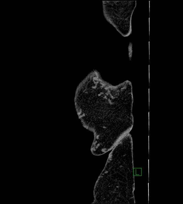 Closed-loop small bowel obstruction-internal hernia (Radiopaedia 78439-91096 C 6).jpg