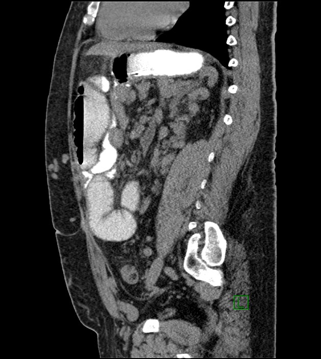 Closed-loop small bowel obstruction-internal hernia (Radiopaedia 78439-91096 C 63).jpg