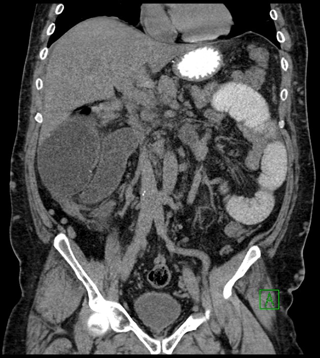 Closed-loop small bowel obstruction-internal hernia (Radiopaedia 78439-91096 Coronal non-contrast 51).jpg