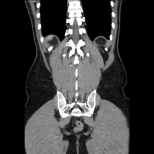 File:Closed-loop small bowel obstruction (Radiopaedia 73713-84509 C 103).jpg