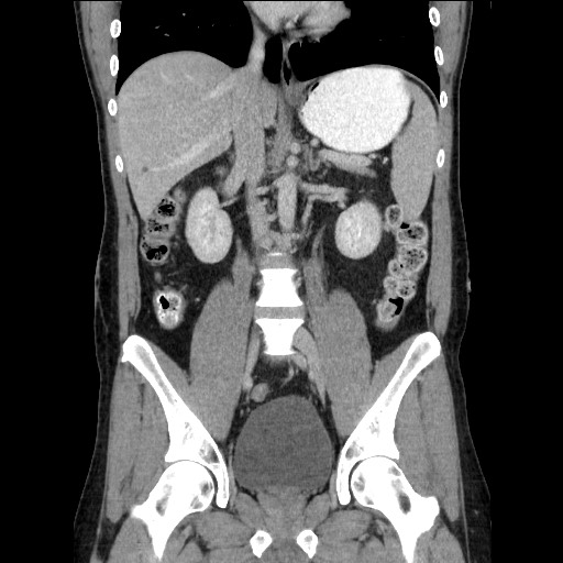 Closed-loop small bowel obstruction (Radiopaedia 73713-84509 C 69).jpg