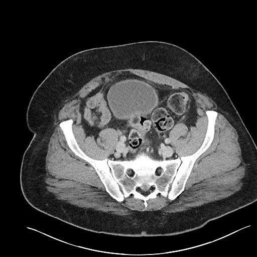 File:Closed loop obstruction - internal hernia into nephrectomy bed (Radiopaedia 59867-67320 A 111).jpg