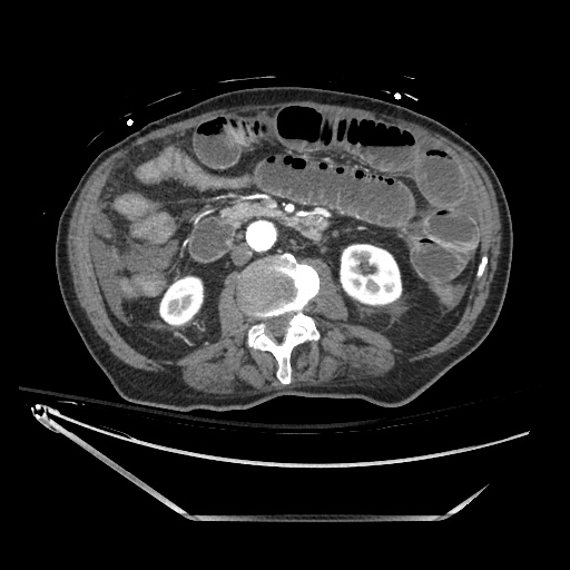 Closed loop obstruction due to adhesive band, resulting in small bowel ischemia and resection (Radiopaedia 83835-99023 B 71).jpg