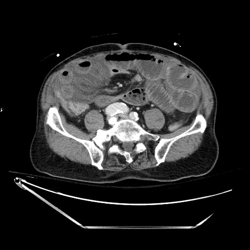 File:Closed loop obstruction due to adhesive band, resulting in small bowel ischemia and resection (Radiopaedia 83835-99023 D 103).jpg