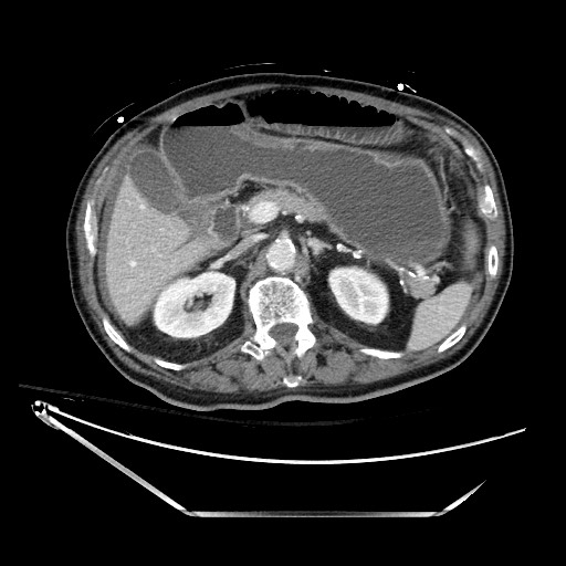 Closed loop obstruction due to adhesive band, resulting in small bowel ischemia and resection (Radiopaedia 83835-99023 D 52).jpg
