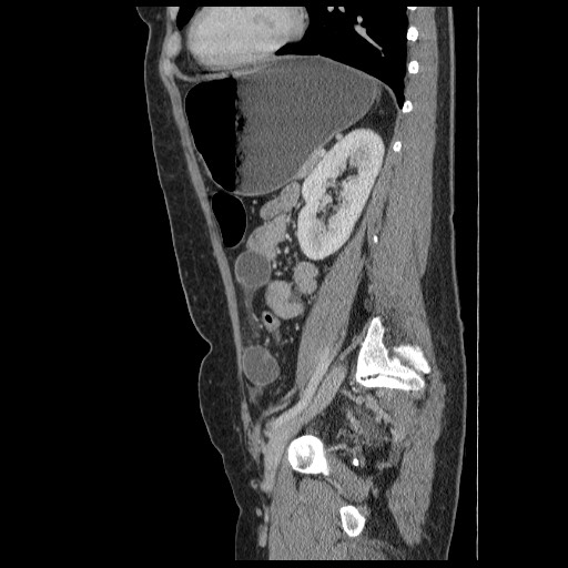 File:Closed loop small bowel obstruction (Radiopaedia 65403-74451 C 73).jpg