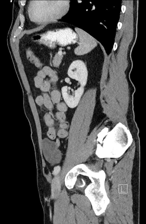 Closed loop small bowel obstruction - internal hernia (Radiopaedia 57806-64778 C 37).jpg