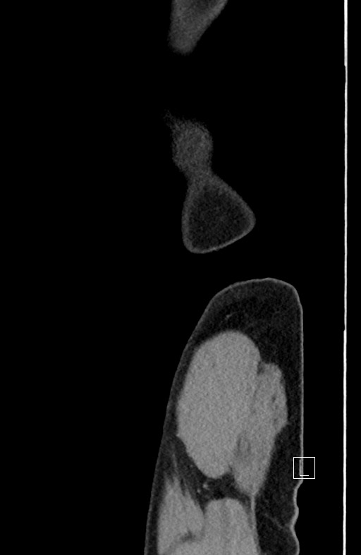 Closed loop small bowel obstruction - internal hernia (Radiopaedia 57806-64778 C 5).jpg