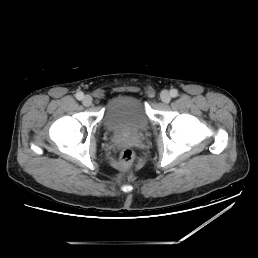Closed loop small bowel obstruction - omental adhesion causing "internal hernia" (Radiopaedia 85129-100682 A 164).jpg