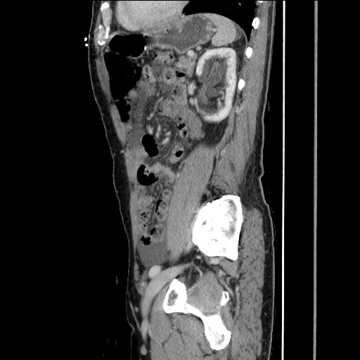 Closed loop small bowel obstruction - omental adhesion causing "internal hernia" (Radiopaedia 85129-100682 C 123).jpg