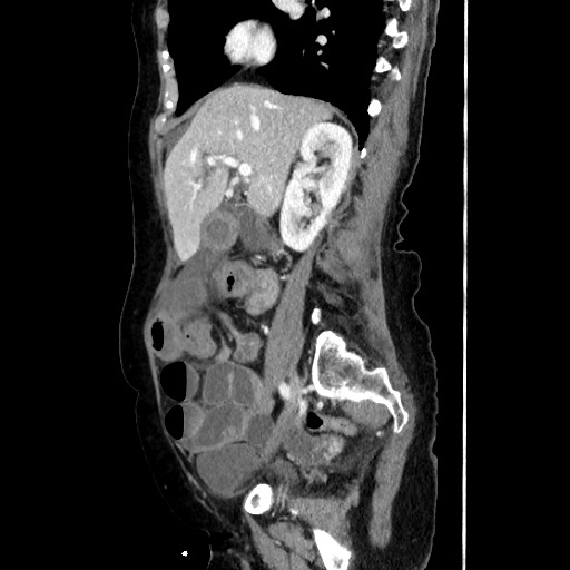Closed loop small bowel obstruction due to adhesive band, with intramural hemorrhage and ischemia (Radiopaedia 83831-99017 D 82).jpg