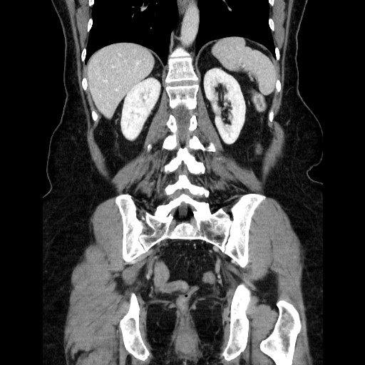 File:Closed loop small bowel obstruction due to adhesive bands - early and late images (Radiopaedia 83830-99015 B 88).jpg
