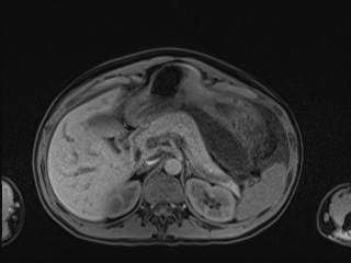 Closed loop small bowel obstruction in pregnancy (MRI) (Radiopaedia 87637-104031 Axial T1 fat sat 36).jpg