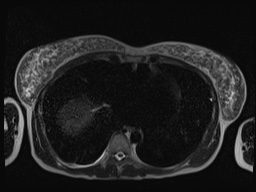File:Closed loop small bowel obstruction in pregnancy (MRI) (Radiopaedia 87637-104031 Axial T2 3).jpg