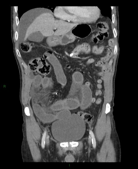 File:Closed loop small bowel obstruction with ischemia (Radiopaedia 84180-99456 B 45).jpg