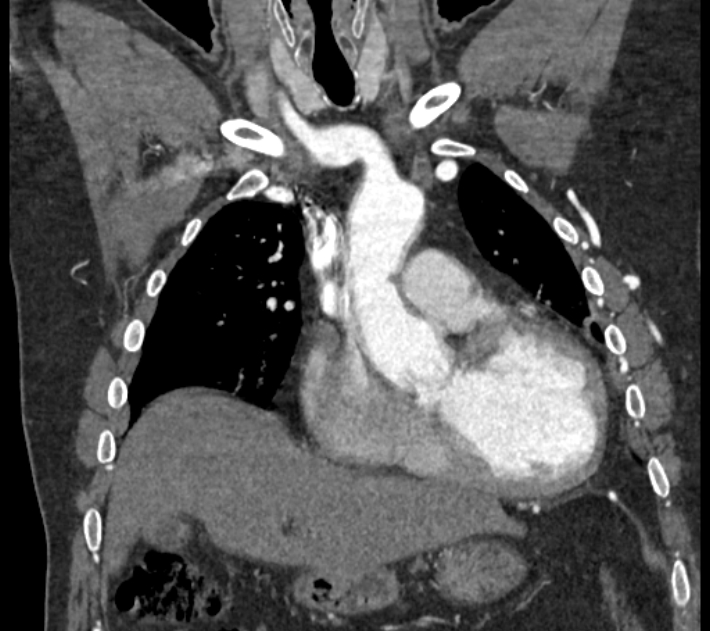 Coarctation of the aorta (Radiopaedia 53752-59822 B 28).jpg