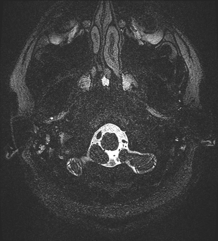 Cochlear incomplete partition type III associated with hypothalamic hamartoma (Radiopaedia 88756-105498 Axial T2 11).jpg