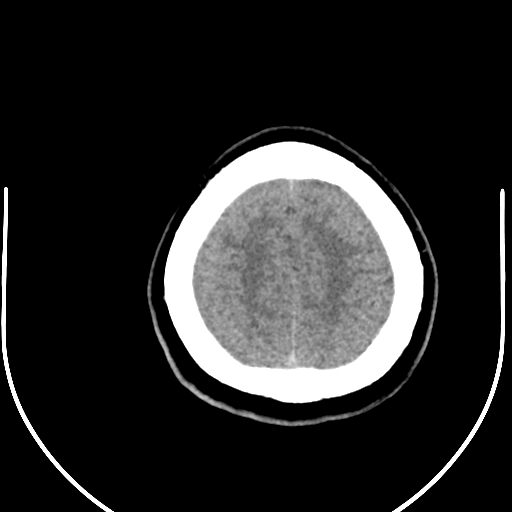 Colloid cyst (Radiopaedia 52865-58792 Axial non-contrast 15).jpg