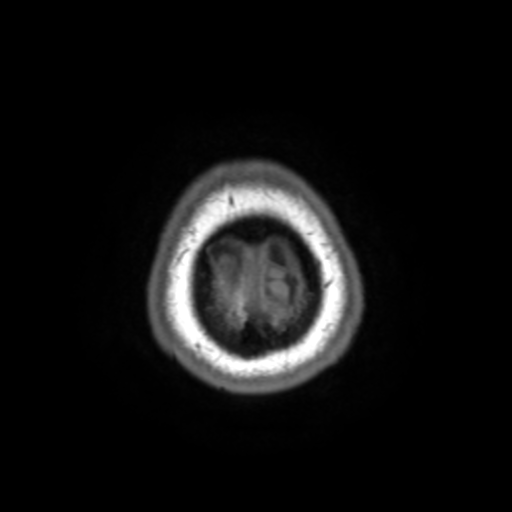 File:Colloid cyst (large) (Radiopaedia 34415-35729 Axial T1 34).png