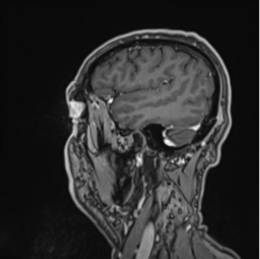 File:Colloid cyst of the third ventricle (Radiopaedia 86571-102662 Sagittal T1 C+ 63).png