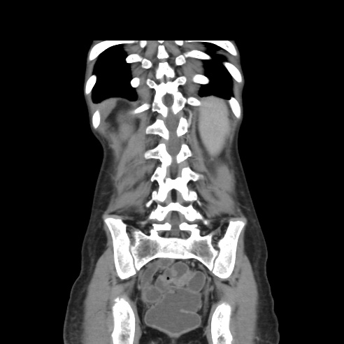 File:Colocolic fistula - Crohn disease (Radiopaedia 57063-63955 B 36).jpg