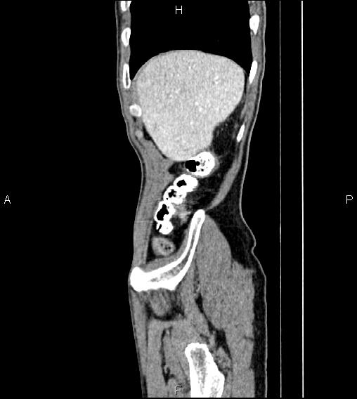 File:Colon adenocarcinoma - hepatic flexure (Radiopaedia 85635-101395 D 10).jpg