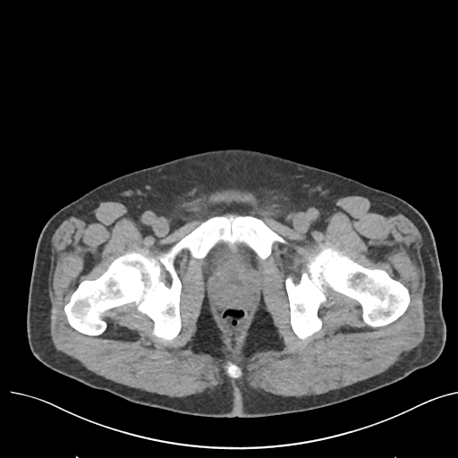 File:Colon adenocarcinoma - splenic flexure (Radiopaedia 34143-35406 Axial Oral contrast 88).png