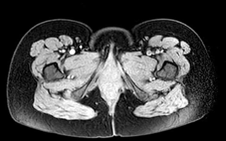 Colon adenocarcinoma with Krukenberg tumors, advanced pregnancy (Radiopaedia 67279-76645 A 2).jpg