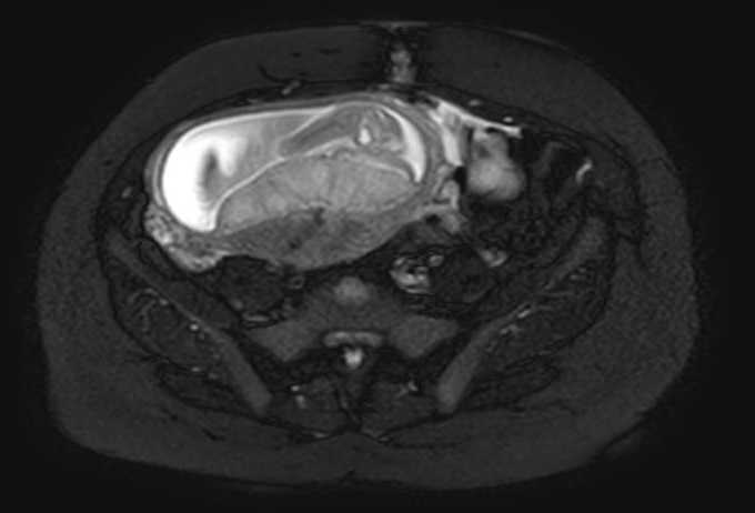 Colon adenocarcinoma with Krukenberg tumors, advanced pregnancy (Radiopaedia 67279-76645 Axial T2 SPAIR 26).jpg