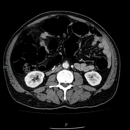 Colon adenocarcinoma with calcific liver metastasis (Radiopaedia 55745-62300 B 22).jpg