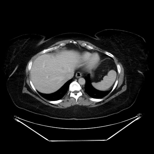 File:Colonic intussusception due to adenocarcinoma (Radiopaedia 86828-102987 A 24).jpg