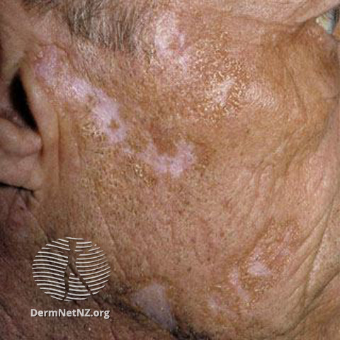 Cutaneous lupus erythematosus (DermNet NZ immune-lupus-erythematosus-2517).jpg