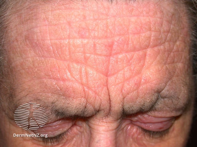 File:Forehead (DermNet NZ dermatitis-atopic37).jpg