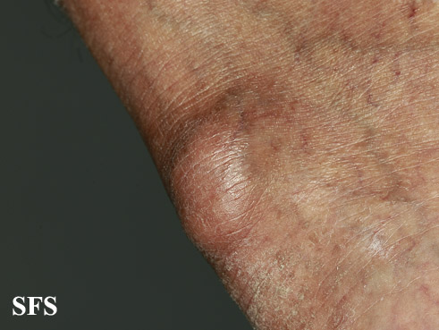 File:Gout (Dermatology Atlas 6).jpg