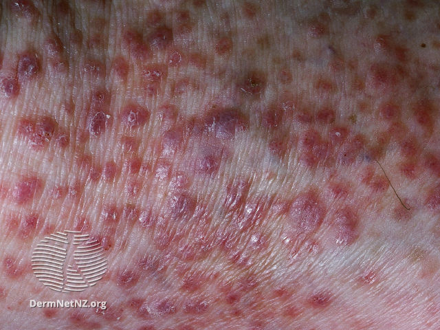 File:Lichen amyloidosis (DermNet NZ lichen-amyloidosis-19).jpg