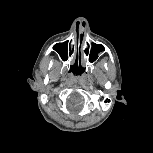 File:Nasal pyogenic granuloma (lobular capillary hemangioma) (Radiopaedia 85536-101244 C 40).jpg
