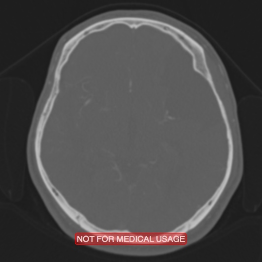 Nasopharyngeal carcinoma recurrence - skull base destruction (Radiopaedia 29107-29490 Axial bone window 56).jpg