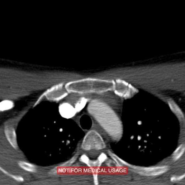 File:Nasopharyngeal carcinoma recurrence - skull base destruction (Radiopaedia 29107-29491 A 42).jpg